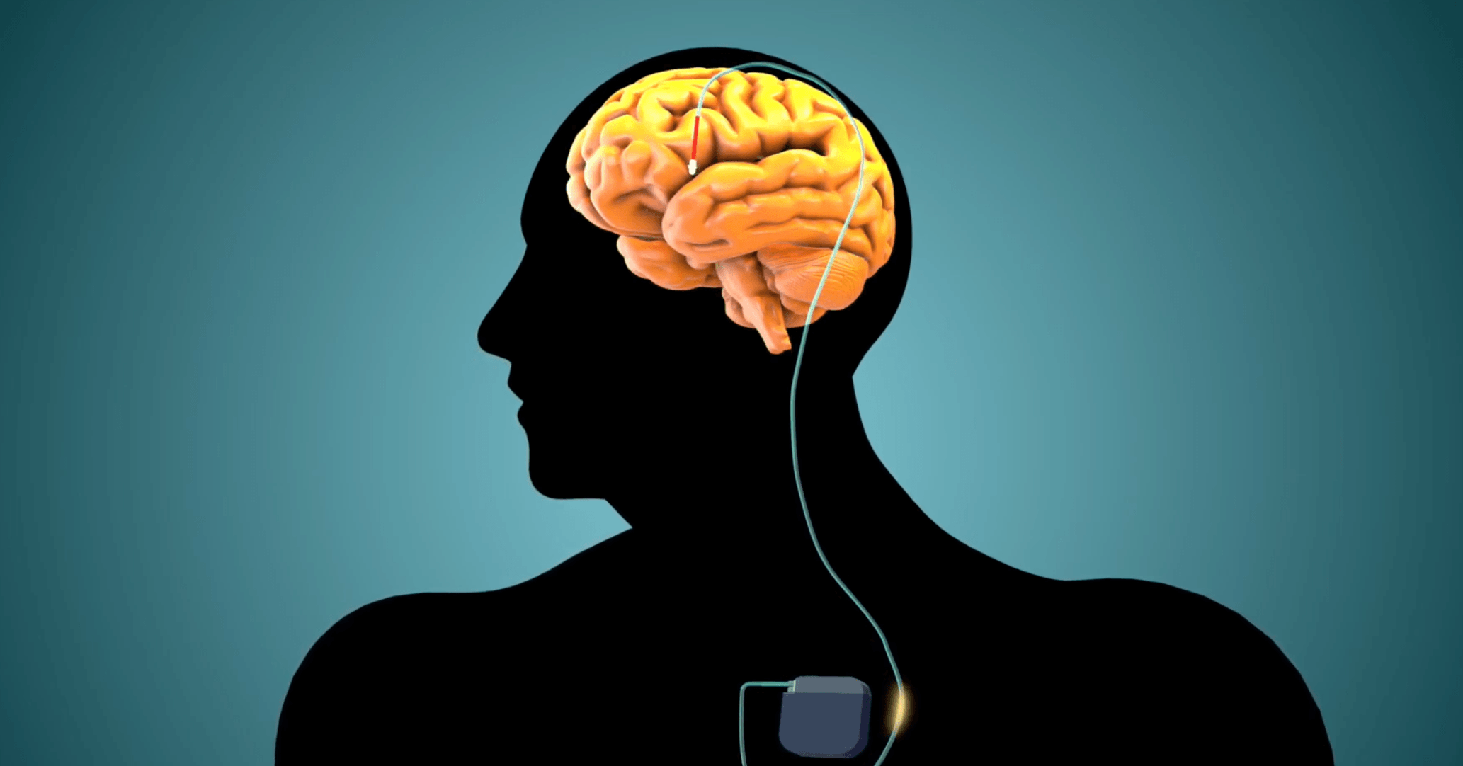 Parkinson's DBS treatment video